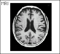 正常な脳のＭＲＩ写真