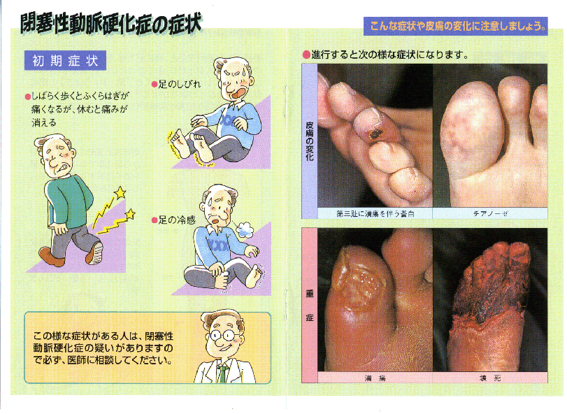 閉塞性動脈硬化症の症状