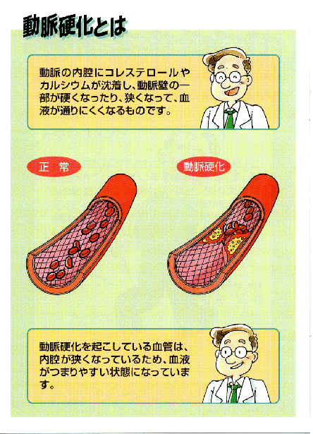 動脈硬化とは