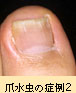 爪水虫の症例2
